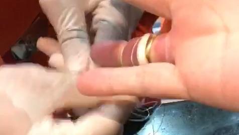 Corpo de Bombeiros usa fio dental para retirar anel preso em dedo de mulher em Fortaleza com-tecnica-que-utiliza-fio-dental-corpo-de-bombeiros-retira-anel-preso-em-dedo-de-mulher.jpg